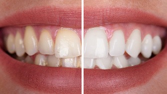 Patient's smile before and after teeth whitening