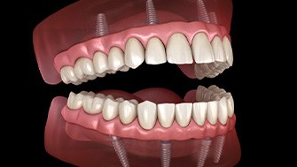 Illustration of all-on-4 dentures