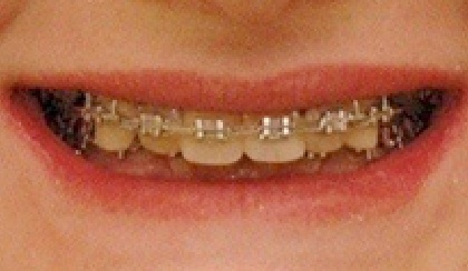 Rebecca smiling after smile makeover