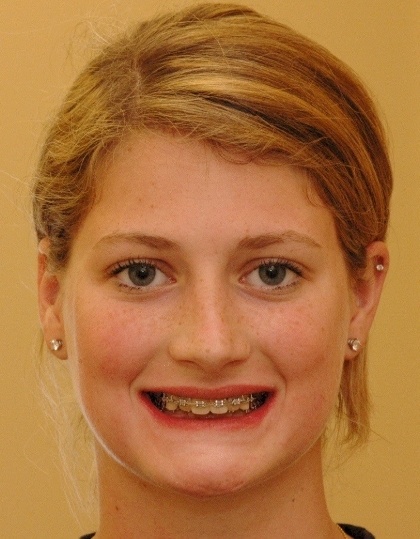 Rebecca smiling before smile makeover