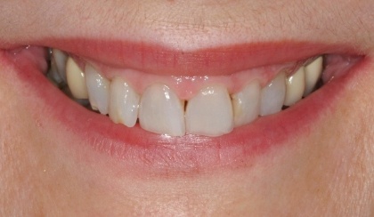 Sherri smiling after smile makeover