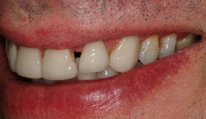 Allen smiling after smile makeover
