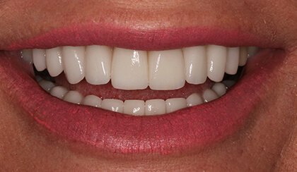 Closeup of Maggie's smile after smile makeover