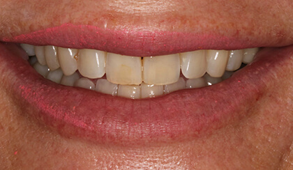 Maggie smiling after smile makeover