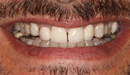 Stan smiling after smile makeover