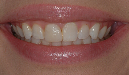 Bronwen smiling after smile makeover