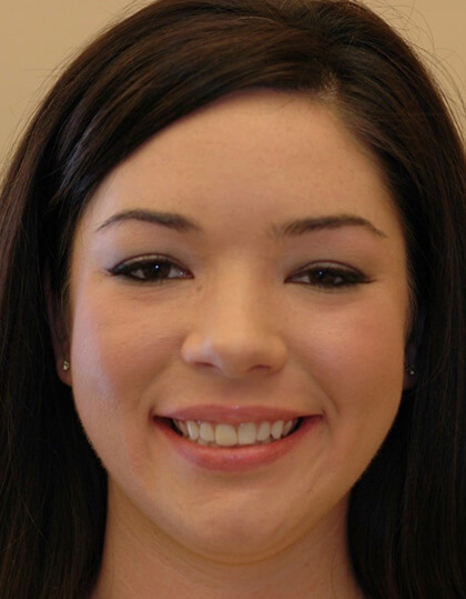 Bronwen smiling before smile makeover