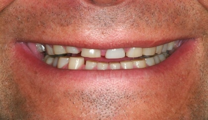 Steve smiling after smile makeover