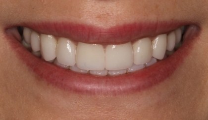 Closeup of Allene's smile after smile makeover