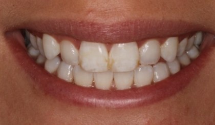 Allene smiling after smile makeover