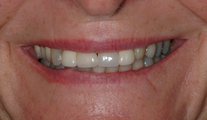 Carolyn smiling after smile makeover
