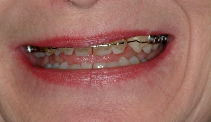 Gail smiling after smile makeover