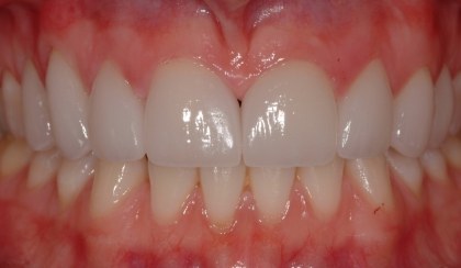 Closeup of Grace's smile after smile makeover