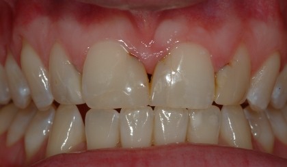 Grace smiling after smile makeover