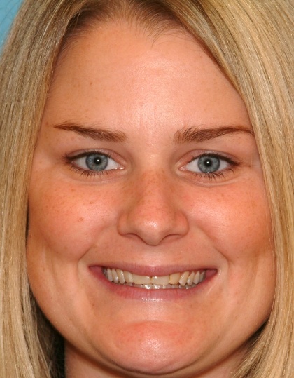 Grace smiling before smile makeover