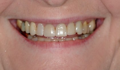 Jan smiling after smile makeover