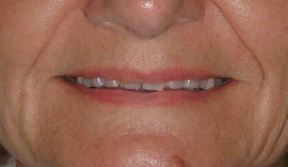 Joanne smiling after smile makeover