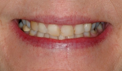 Linda smiling after smile makeover