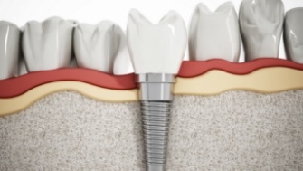 Dental patient looking at dentist during initial dental implant consultation