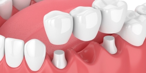 Animated smile during dental bridge placement