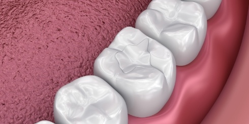 Animated teeth with dental sealants