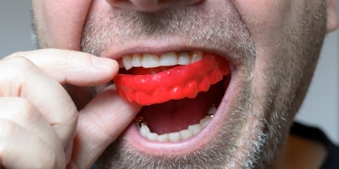 Closeup of dental patient placing athletic mouthguard