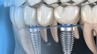 a graphic illustration of an implant-supported bridge